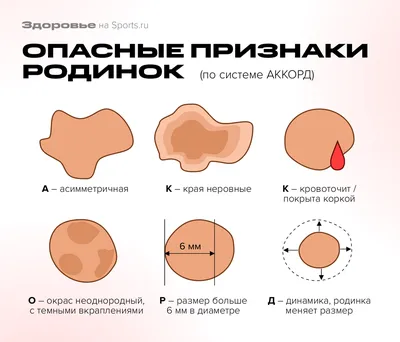 Почему на самом деле появляются родинки? Как понять, какие из них опасны? |  Sports.ru | Дзен