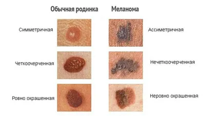 Сколько должно быть родинок: дерматологи советуют пересчитать. Особенно на  спине