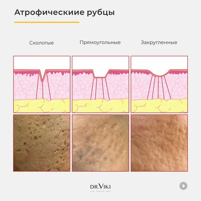 Рубец (шрам) — плотное образование соединительной ткани (преимущественно  коллагена), возникшее вследствие повреждения кожи (травма, разрез, ожог)  или после воспалительного процесса (например, это к вопросу рубца от  воспаления после акне)