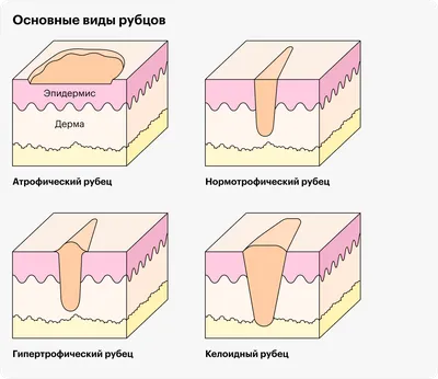 Как избавиться от шрамов?: статьи клиники Оксфорд Медикал Киев