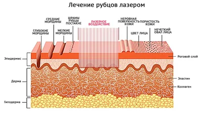 Инъекционное удаление рубцов, растяжек и шрамов, как это происходит. |  Клиника \"Отражение\"