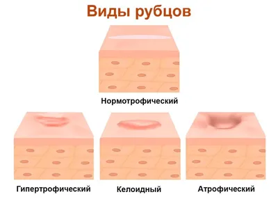 Врач дерматокосметолог Мари Мануковна - Сегодня рубцы вызывают у окружающих  только сочувствие и говорят, по меньшей мере, о безразличном отношении  хозяев рубцов к собственному телу 😒 ⠀ Потому что излеченный вовремя рубец