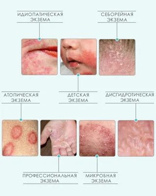 Сыпь на теле - причины, симптомы и лечение высыпаний на коже | Mriya Med