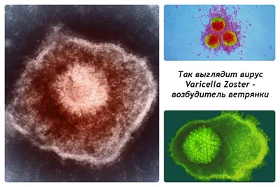Ветряная оспа у детей. Рекомендации. | Медицинский центр Доверие