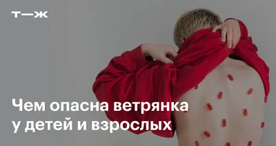 Симптомы ветрянки у детей