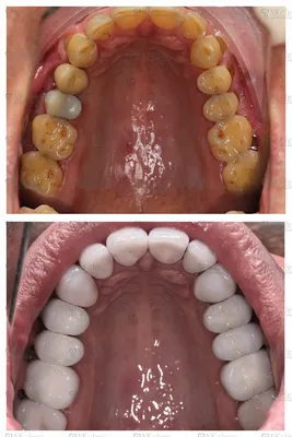 Установить виниры на зубы в Москве | НК Клиник