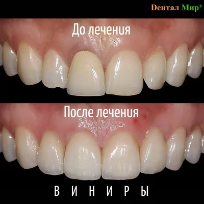 Виниры на зубы – стоимость с установкой в Москве | Damas Medical Center