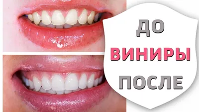 Виниры emax: цена и примеры пациентов, которым они нужны