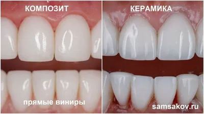 Виниры E.MAX CLASSIC - Центр клеточной и молекулярной стоматологии «Бионик  Дентис»