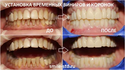 https://kes.com.ua/services/veneers/