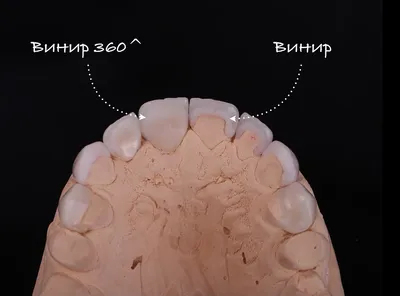 Зубные накладки-виниры - Стоматология \"Скаковский\"