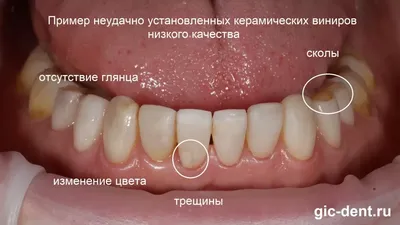 Керамічні вініри. Ціни на керамічні вініри [2022] з установкою у м. Харків