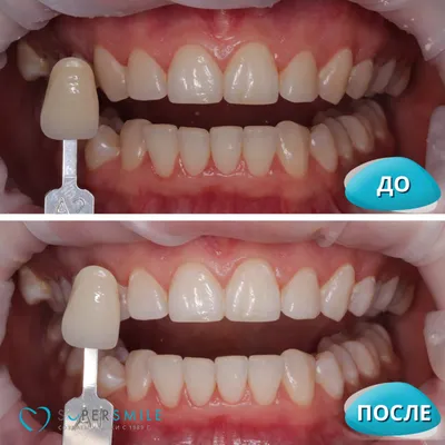 Установка виниров и коронок женщинам после 50 лет. Клиника Smile STD в  Измайлово