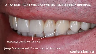 Как правильно выбрать цвет для виниров? - Новости о стоматологии