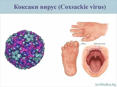 Проверка слуха: На Южном берегу Крыма гуляет вирус Коксаки - KP.RU