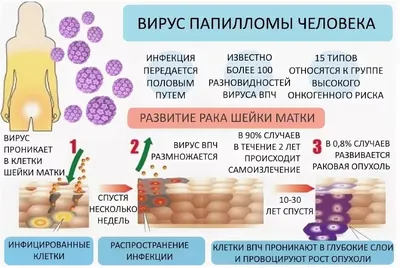 Вирус папилломы человека (ВПЧ): симптомы, причины, лечение