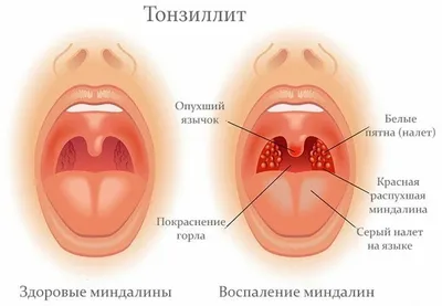 Вирусный тонзиллит фото