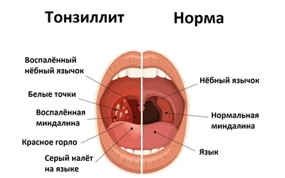 Тонзиллит - причины появления, симптомы заболевания, диагностика и способы  лечения