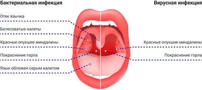 Стенокардия Фарингит И Тонзиллит Тонзиллит Бактериальный И Вирусный  Инфекция Миндалин Открытый Рот Анатомия — стоковая векторная графика и  другие изображения на тему Миндалина - iStock