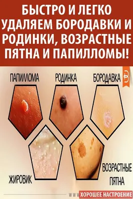 Удаление папиллом и бородавок в Москве - получите консультацию косметолога  в Face Clinic