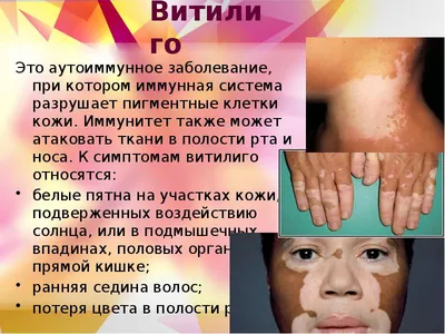 Шампунь от зуда и шелушений кожи головы Neutrogena T/Gel® Therapeutic  Shampoo 130 мл (ID#1341139072), цена: 372 ₴, купить на Prom.ua