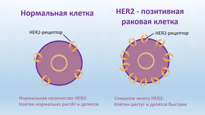 Терапия медикаментом Trastuzumab Emtansin (Kadcyla) в Германии