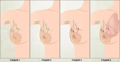 Рак молочной железы: симптомы и особенности лечения | ООО «Геномед»