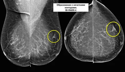 Киста молочных желез: симптомы, причины, диагностика, лечение