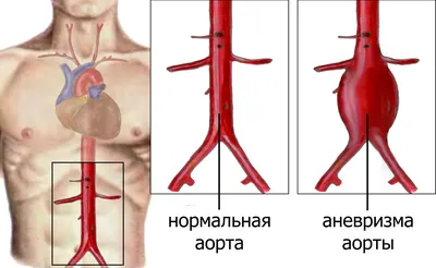 Инфаркт миокарда - КГБУЗ \"МАНСКАЯ РАЙОННАЯ БОЛЬНИЦА\"