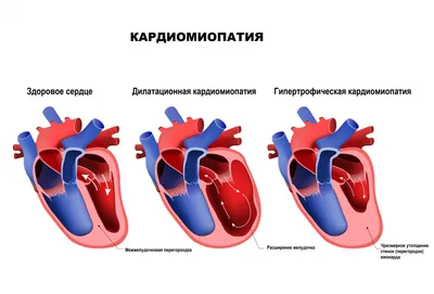 Внешние признаки смерти от тромба фото