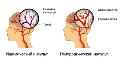 Отрыв тромба: причины, симптомы и последствия. Почему наступает смерть от  тромба - 20 декабря 2019 - 63.ru