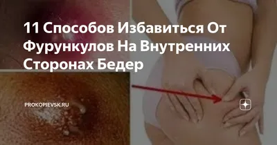 Фурункулы у ребенка: причины появления, признаки, диагностика и лечение —  Статьи — ОН КЛИНИК Бейби