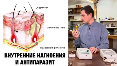 Ячмень на глазу: чем лечить, как избавиться, быстрое лечение. Как выглядит  ячмень на фото. Как убрать ячмень с глаза у ребенка