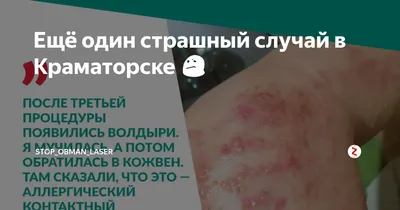 7 типов экземы – причины, симптомы, лечение - Профессорская клиника