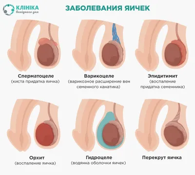 Операция ГИДРОЦЕЛЕ (водянка яичка) | Клиника Николая Доценко