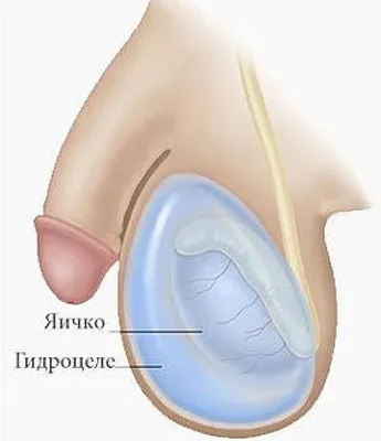 Гидроцеле. Водянка яичка. Симптомы, последствия и лечение водянки яичка у  мужчин | Хирург Щевцов - YouTube