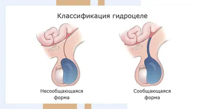 Водянка яичка у ребенка: симптомы, диагностика и лечение