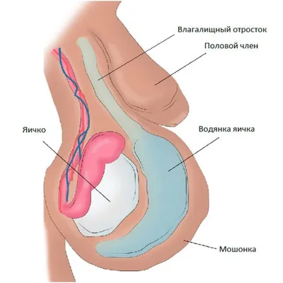 Водянка оболочек яичка (Гидроцеле) у мальчика – симптомы, причины, лечение  - Азбука здоровья