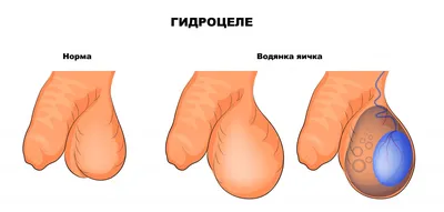 Лечение (операция удаления) водянки яичка (гидроцеле) у мужчин