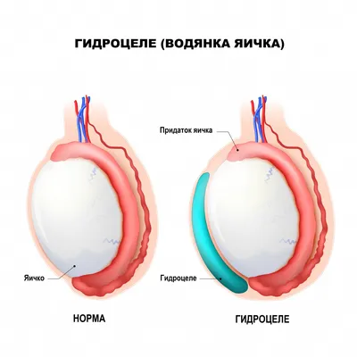 Водянка яичка фото