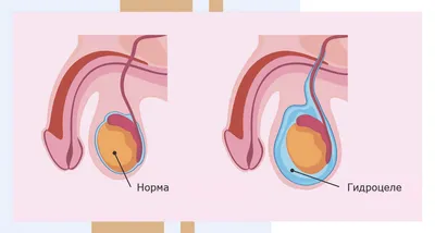 Операция ГИДРОЦЕЛЕ (водянка яичка) | Клиника Николая Доценко