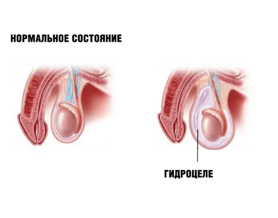 Гидроцеле (водянка яичка): симптомы, причины и лечение в клинике АльтраВита