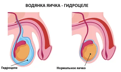 Гидроцеле современные методы лечения - малоинвазивные операции -  Швейцарская Университетская Клиника