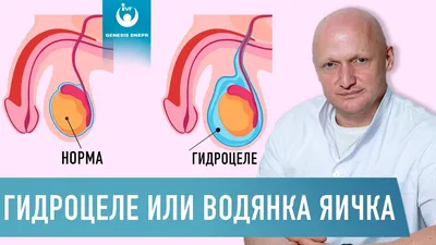 Водянка оболочек яичка (гидроцеле) операция – Лечение водянки у  новорожденных мальчиков в центре андрологии в Москве!