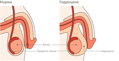 Гидроцеле (водянка яичка): симптомы, причины и лечение в клинике АльтраВита