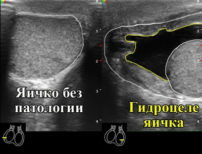 Гидроцеле (водянка яичка), причины и лечение. Операция при водянке яичка.