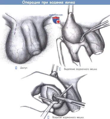 Лечение водянки яичка у детей в Приморском районе СПБ. Цены, врачи, запись