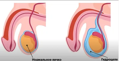 Водянка яичка - гидроцеле и армия: что должен знать призывник