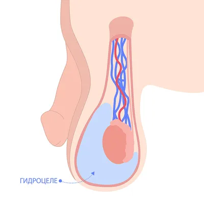 Водянка яичка у мужчин: лечение, причины, симптомы, удаление водянки яичка.  Урология