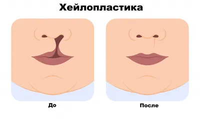 Заячья губа у детей: фото, причины, симптомы, лечение